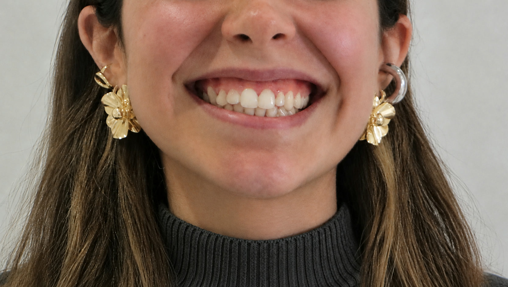 Antes de tratamiento de sonrisa gingival, paciente de la Dra. Brenda López