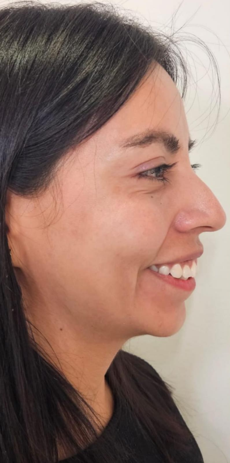 Antes de rellenos de ácido hialurónico, paciente de la Dra. Brenda López