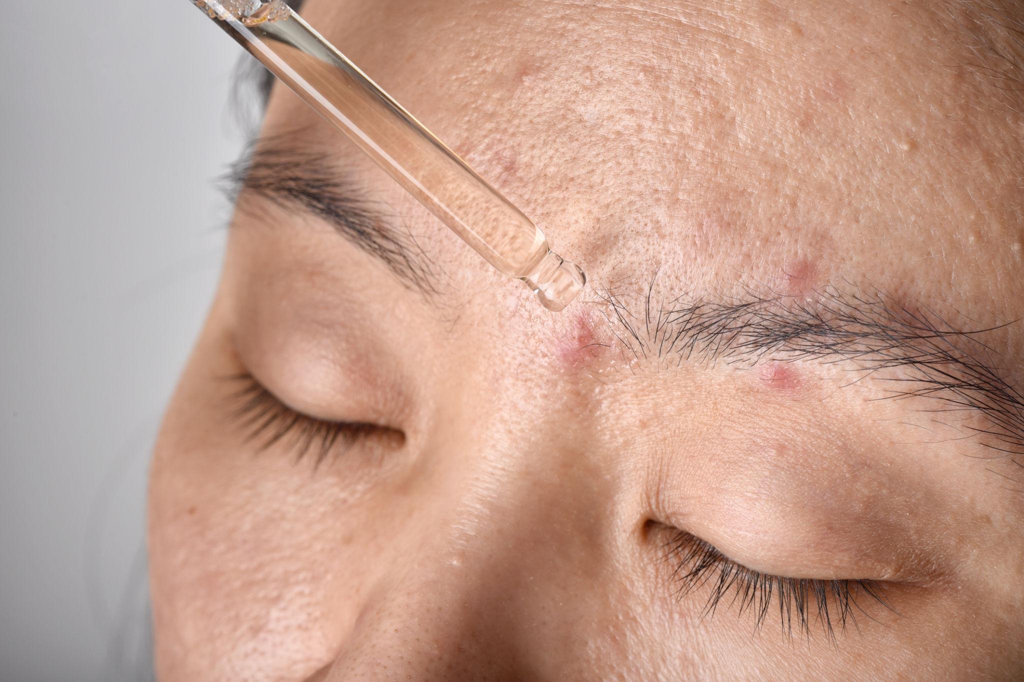 Peeling facial en San Jerónimo, CDMX